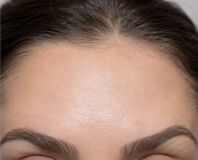 Anti Wrinkle - After
