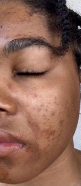 Chemical Peel - Before