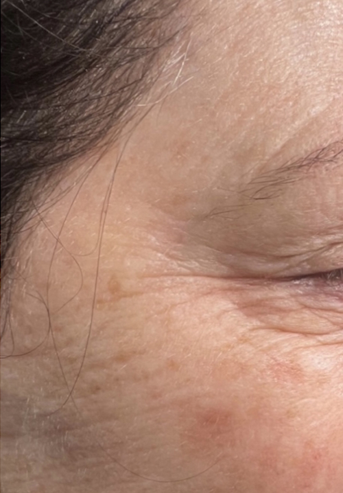 Skin Booster After