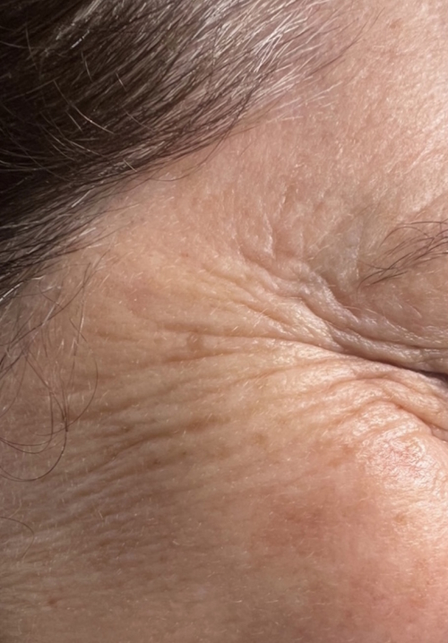 Skin Booster – Before Skin Booster - Before